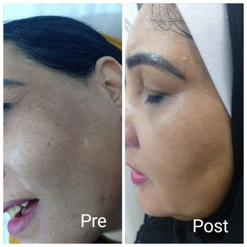 تفتيح وتوحيد لون البشرة في الغردقة